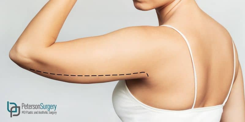 Body Contouring What Is An Arm Lift